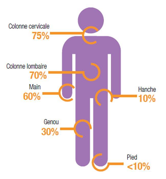 Arthrose du genou : HappyCross soulage la douleur et améliore la